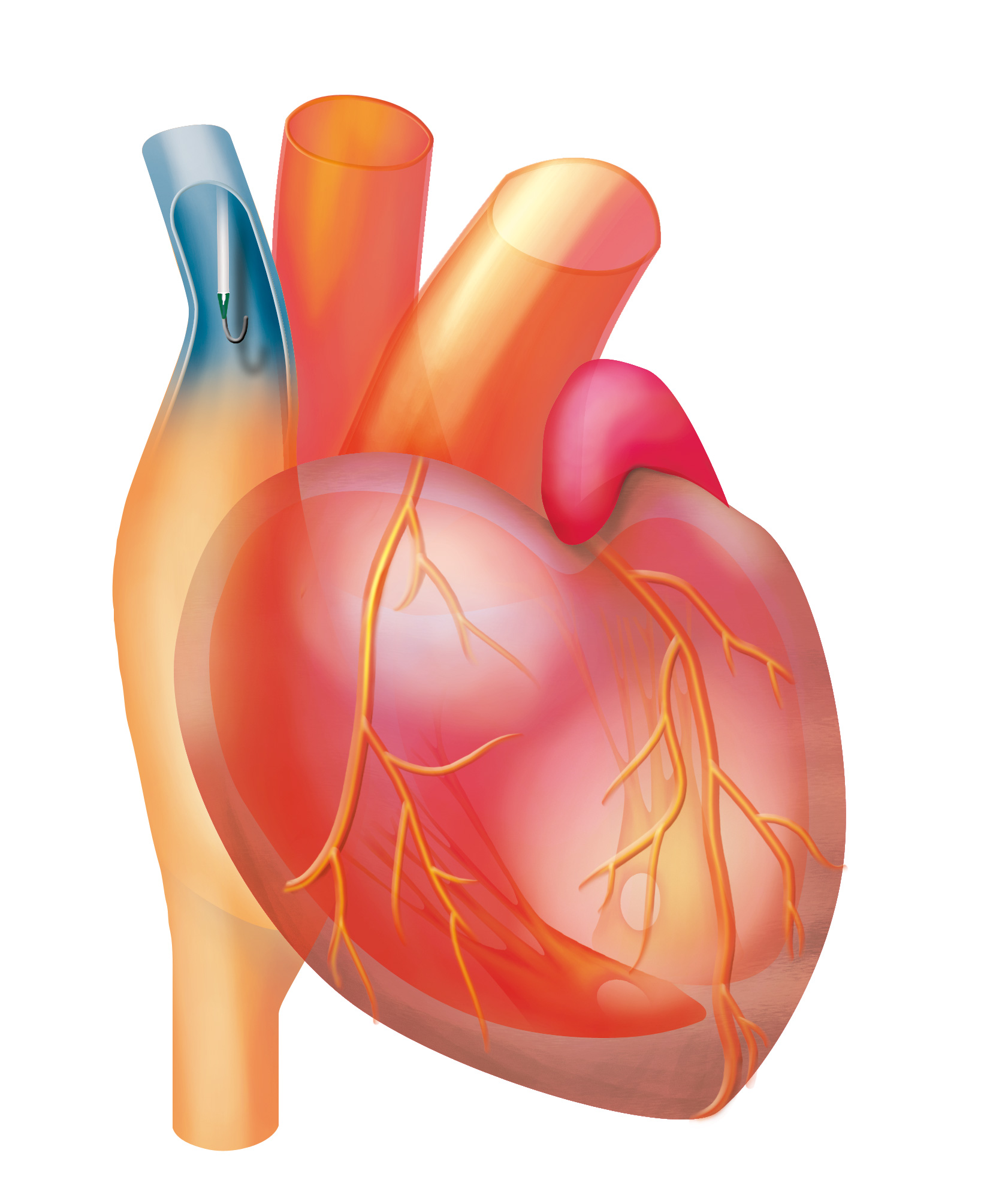 Certofix Vena Cave Superior