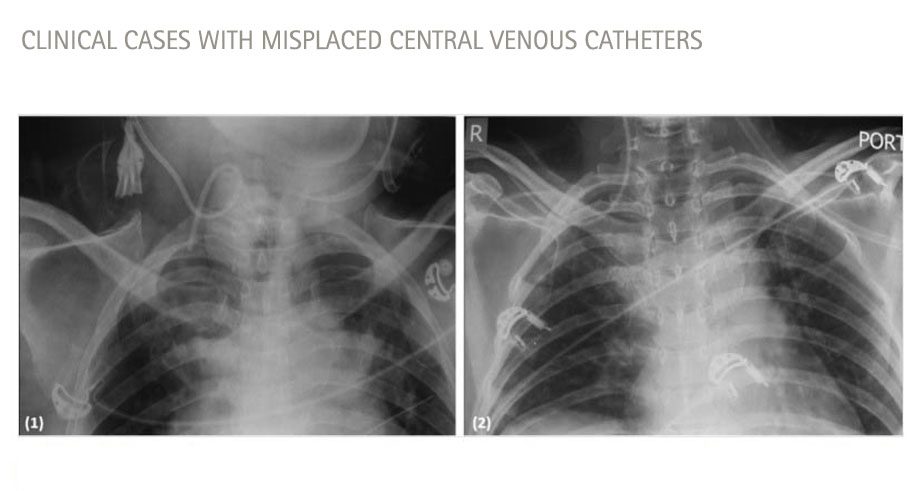 Clinical cases with misplaced cvcs