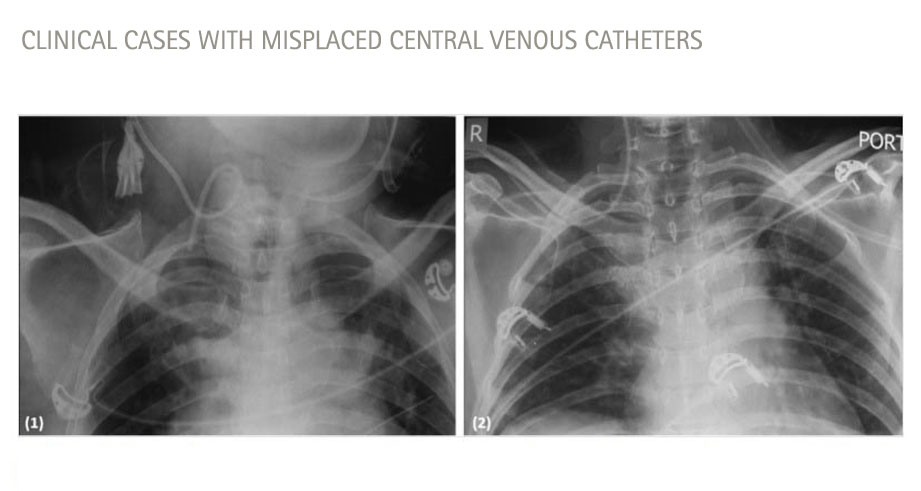 Clinical cases with misplaced cvcs