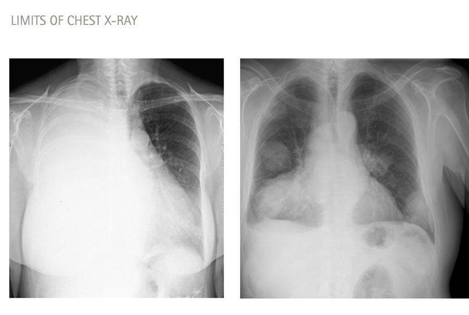 Limits of chest x-ray