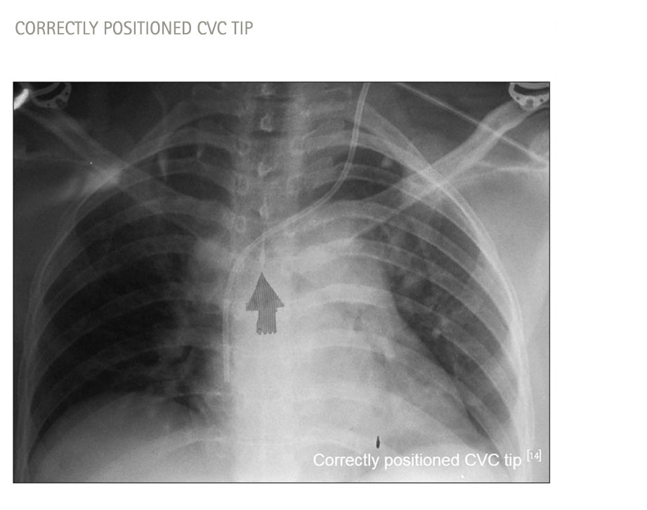 Correctly positioned CVC tip