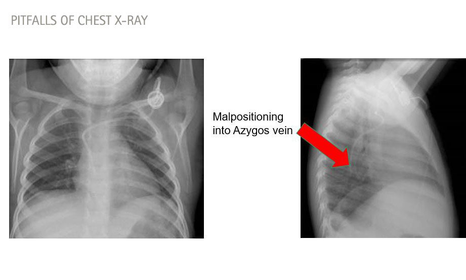 Ptfalls of chest x-ray