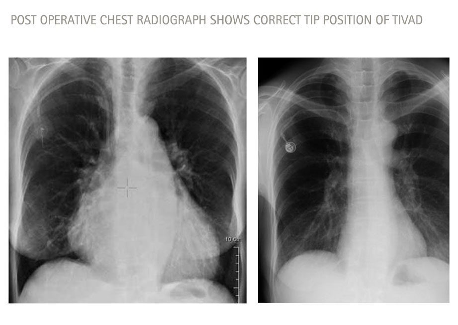 Post operative chest radiograph