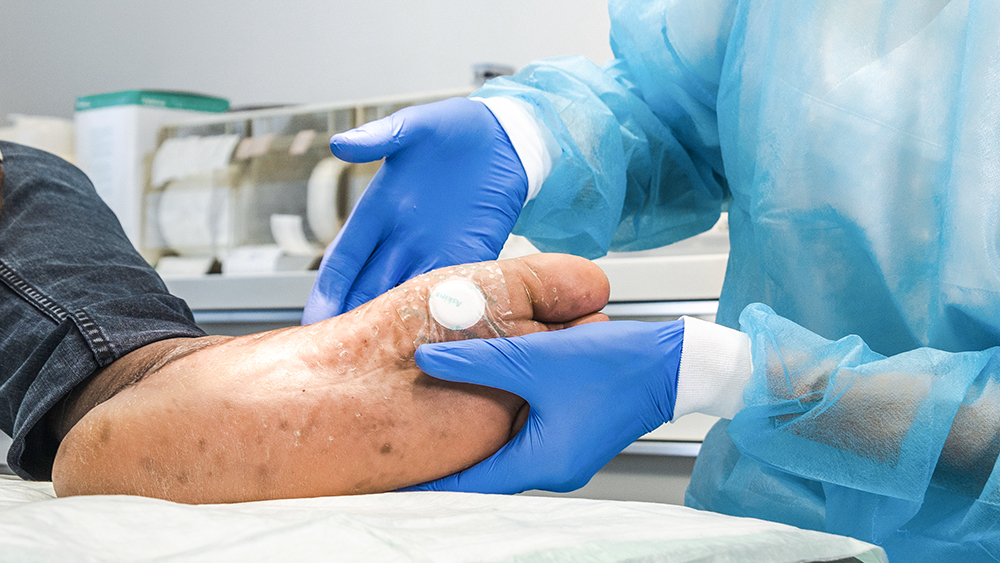 Two hands with gloves examine a foot with a plaster on it.
